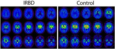 Serotonin transporter density in isolated rapid eye movement sleep behavioral disorder